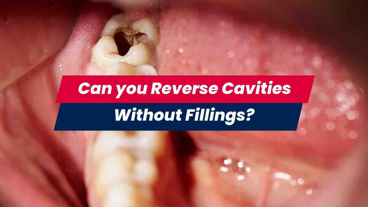 Can You Reverse Cavities and not Get Fillings? | USHEALTH Group