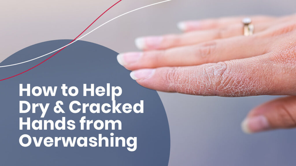 How to Treat Dry, Cracked Hands from Overwashing Affordable Health Coverage Plan Quotes