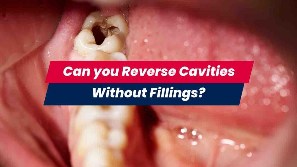 Can You Reverse Cavities And Not Get Fillings Affordable Health can-you-reverse-cavities-and-not-get-fillings-affordable-health