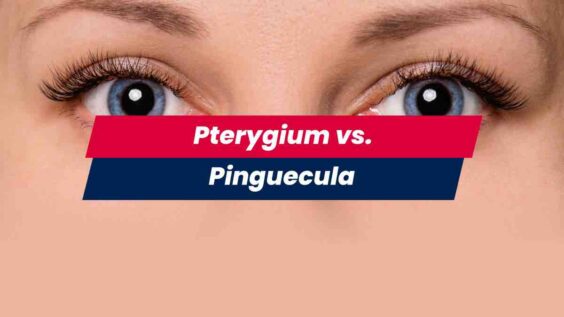 Woman's eyes showing pterygium vs pinguecula