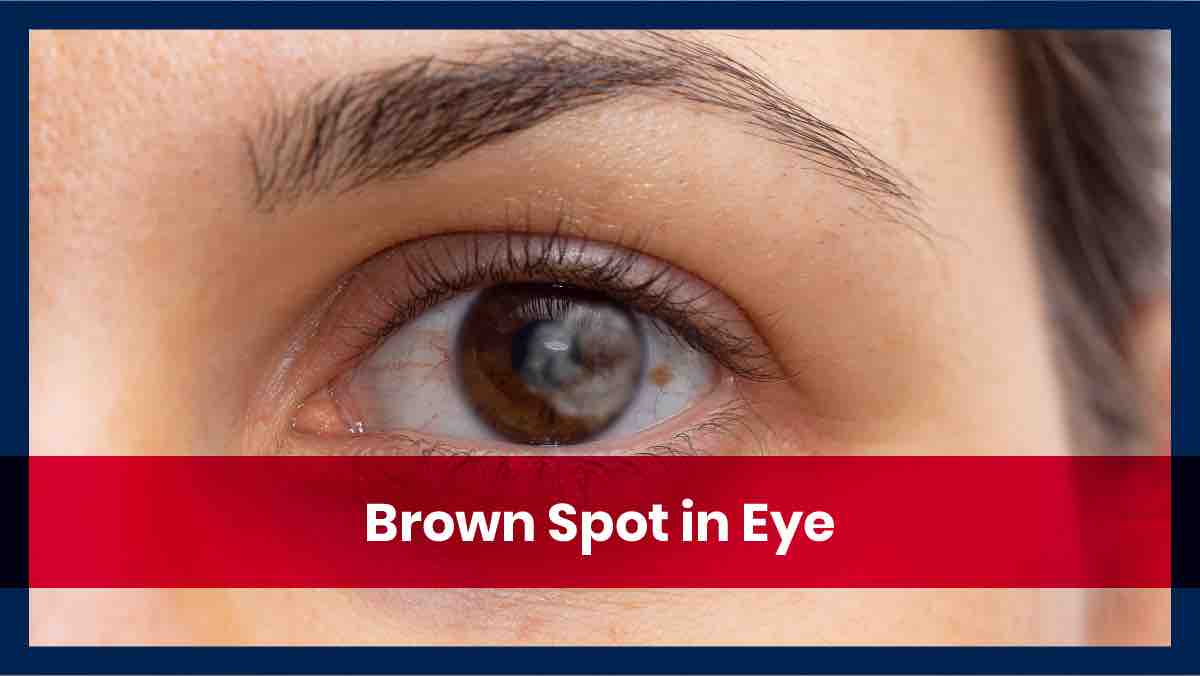 a close up of a persons brown colored eye with a brown spot on their eye on the right side