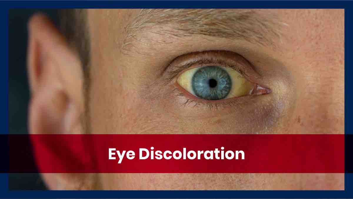 Discoloration of white of the eye